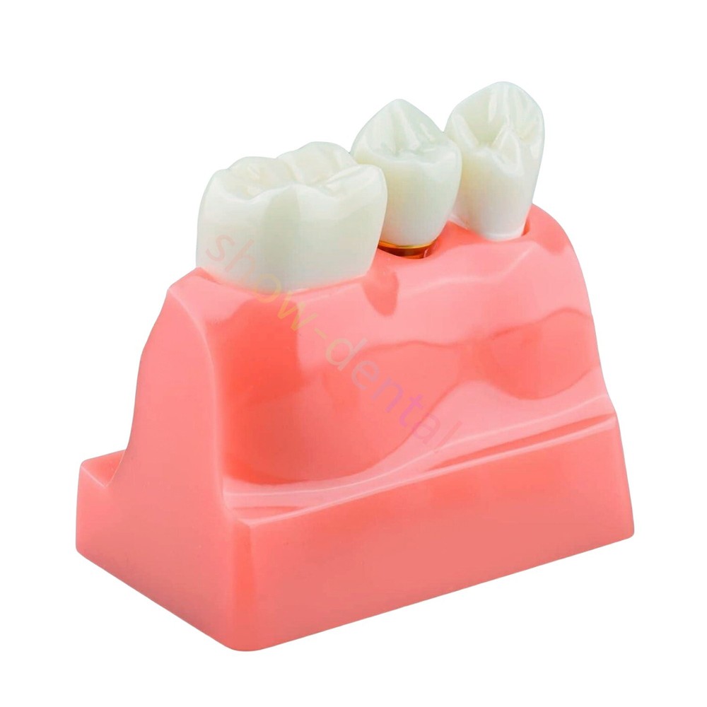 Dental Implant Analysis Removable Crown Teeth Model Analysis Study Model