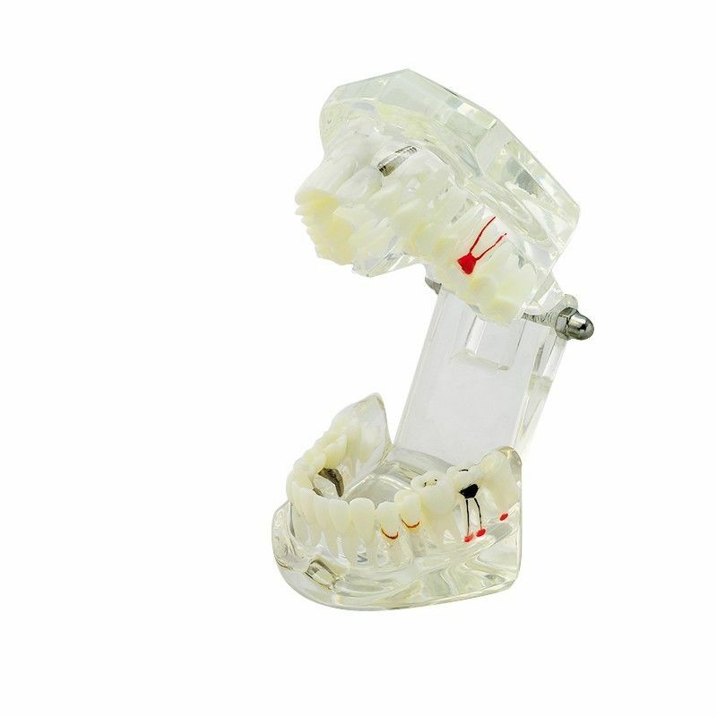 Dental Demonstration Model Teach Study Implant Bridge Restoration & Pathology