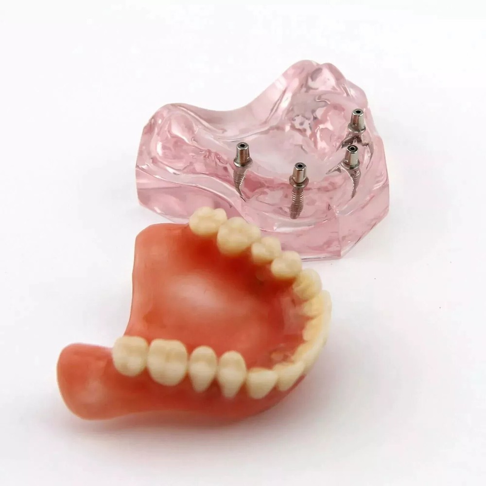 Dental Restoration Teeth Typodont Implants Model Demonstrate Overdenture 3 Model