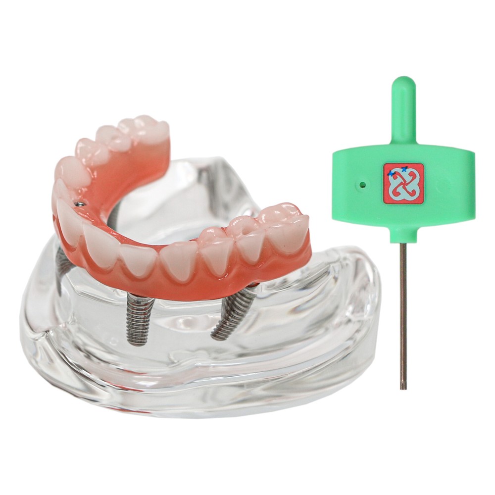 Dental Implant Model PRD Removable Partial Dentures Overdenture treatment Model