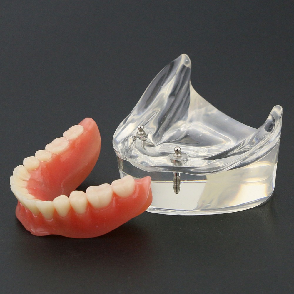 Sale Dental Model #6002 Overdenture Inferior 2 Implants Restroration Study 1Set