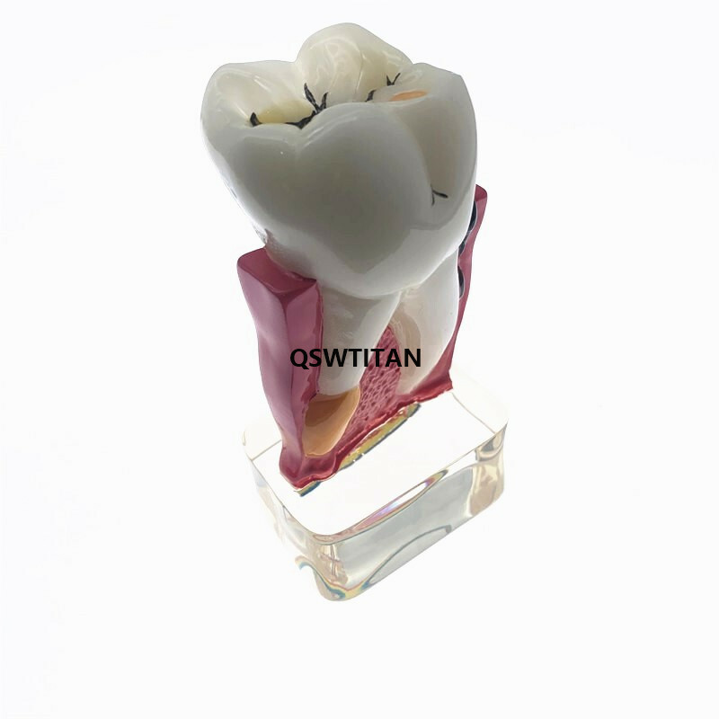 Teeth Model 4 times tooth pathology Comprehensive Periodontal teaching models