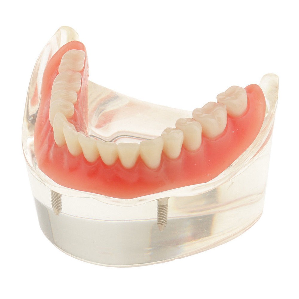 Dental Implant Teeth Model Removable Restoration Overdenture 2 Precision Lower