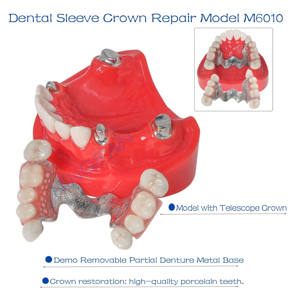 Dental Typodont Removable Partial Denture Model ,PRD Telescopic Crown Denture