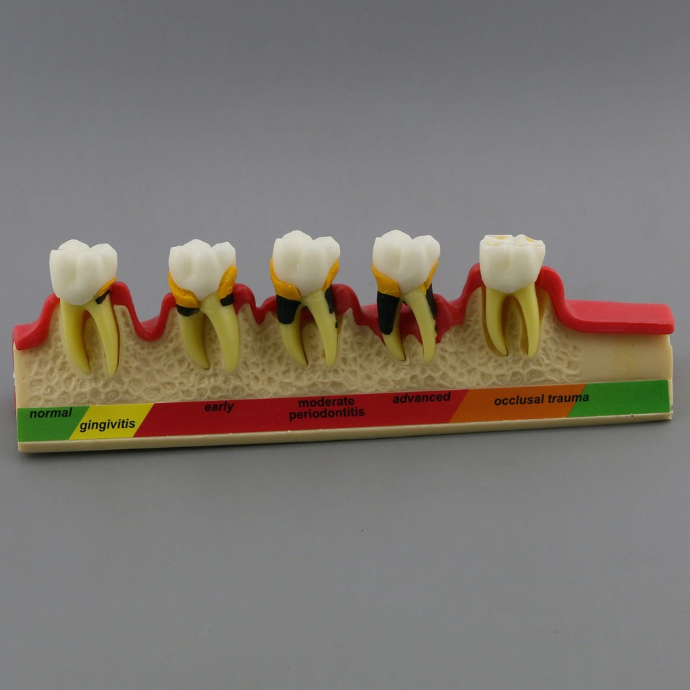 Dental Study Teaching Model Periodontal Disease Assort Teeth Dentoform Typodont