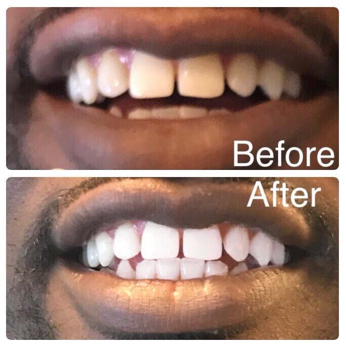 Teeth Whitening tooth Smart phone LED bright Light for iPhone, Android, USB