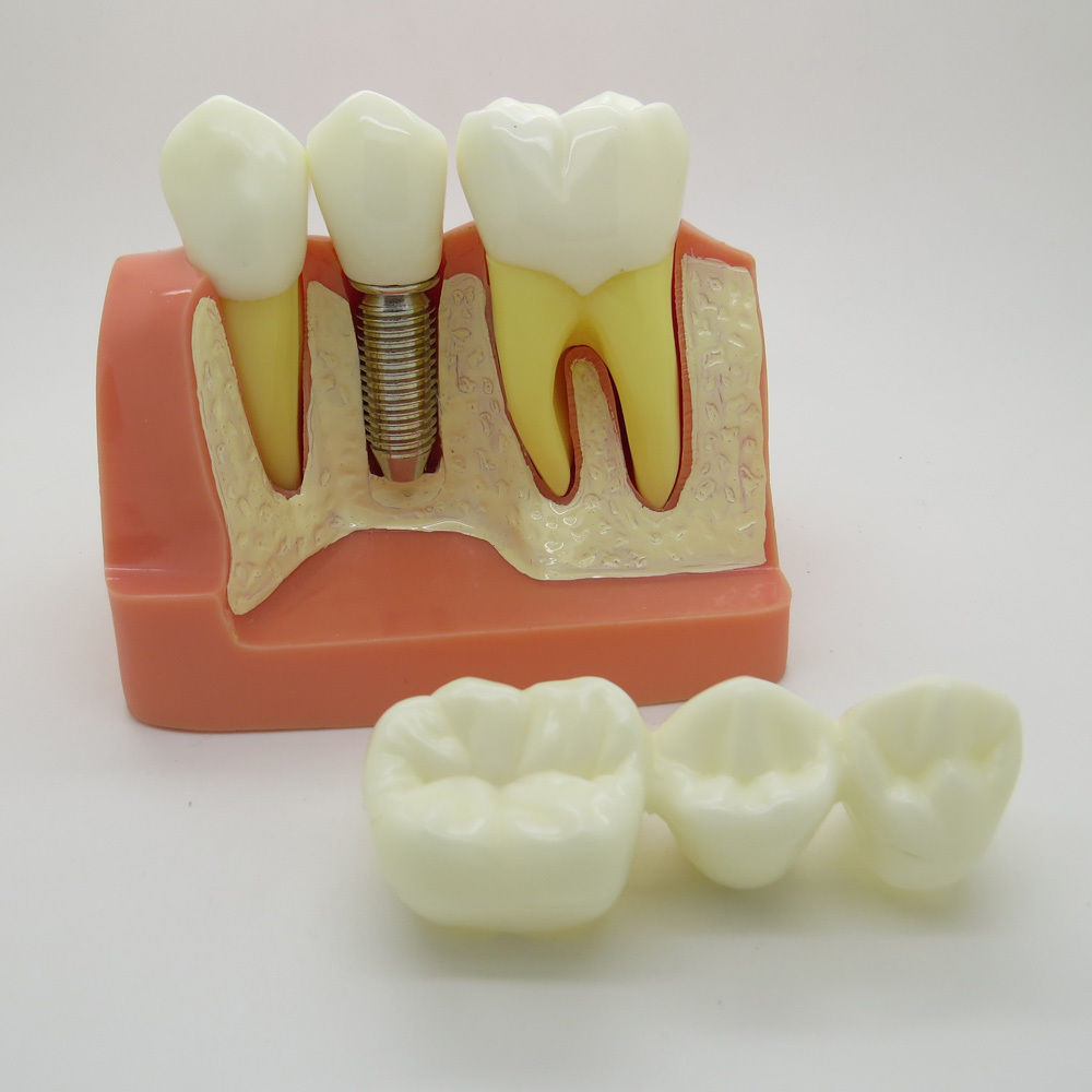 New Implant Analysis Dental Crown Bridge Demonstration Teeth Model Study Model
