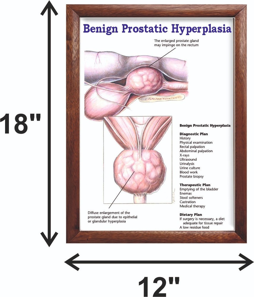 Benign Prostatic Hyperplasia Chart 12x18 inches