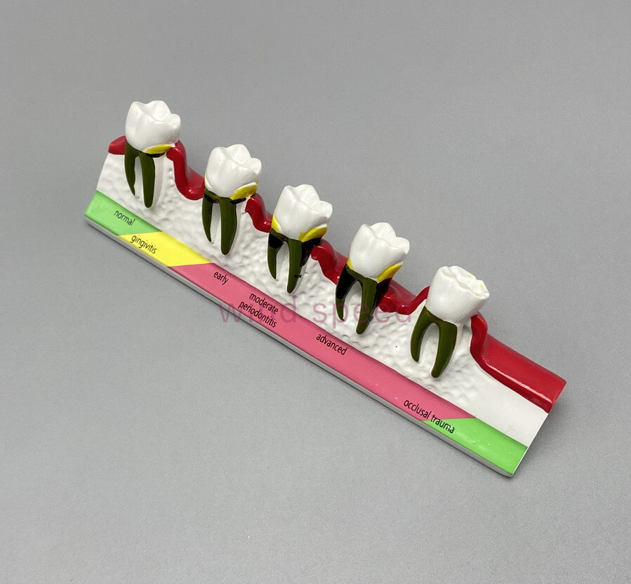 Dental Typodont Teeth Study Teach Model Implant Endo Caries Demonstration