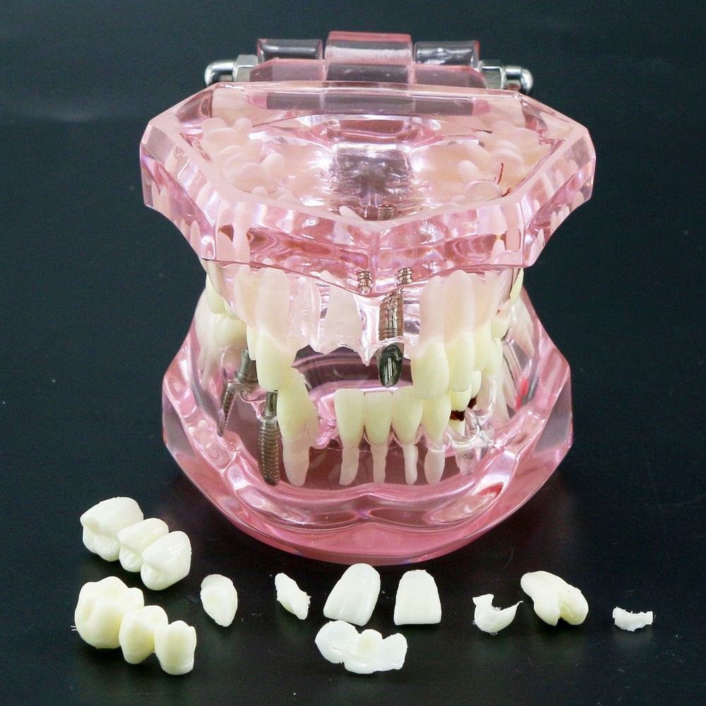 Dental Model Bridge Restoration Pathology Study Demo Teaching Model M2001
