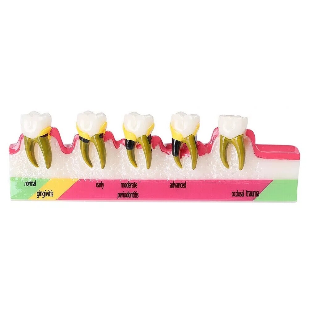 Dental Study Teaching Model Periodontal Disease 5-Stage Teeth Dentoform Typodont