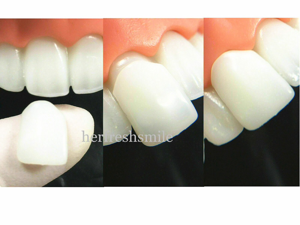 2Set Dental Composite Veneer Template Model Practise Veneers Dentist Teaching