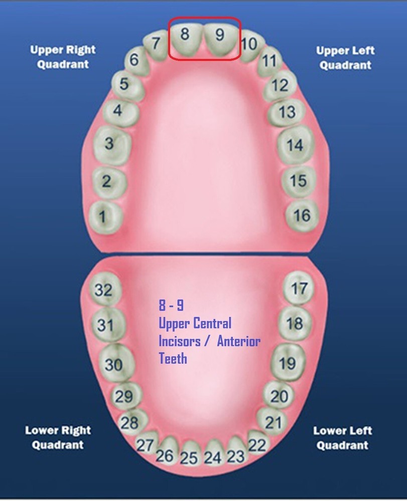 DENTAL POLYCARBONATE TEMPORARY CROWNS #19 (ULC) UPPER LEFT CENTRAL 5/PACK