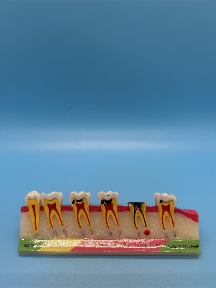Dental Caries Developing illusteation teeth disease Tooth Model Demonstration