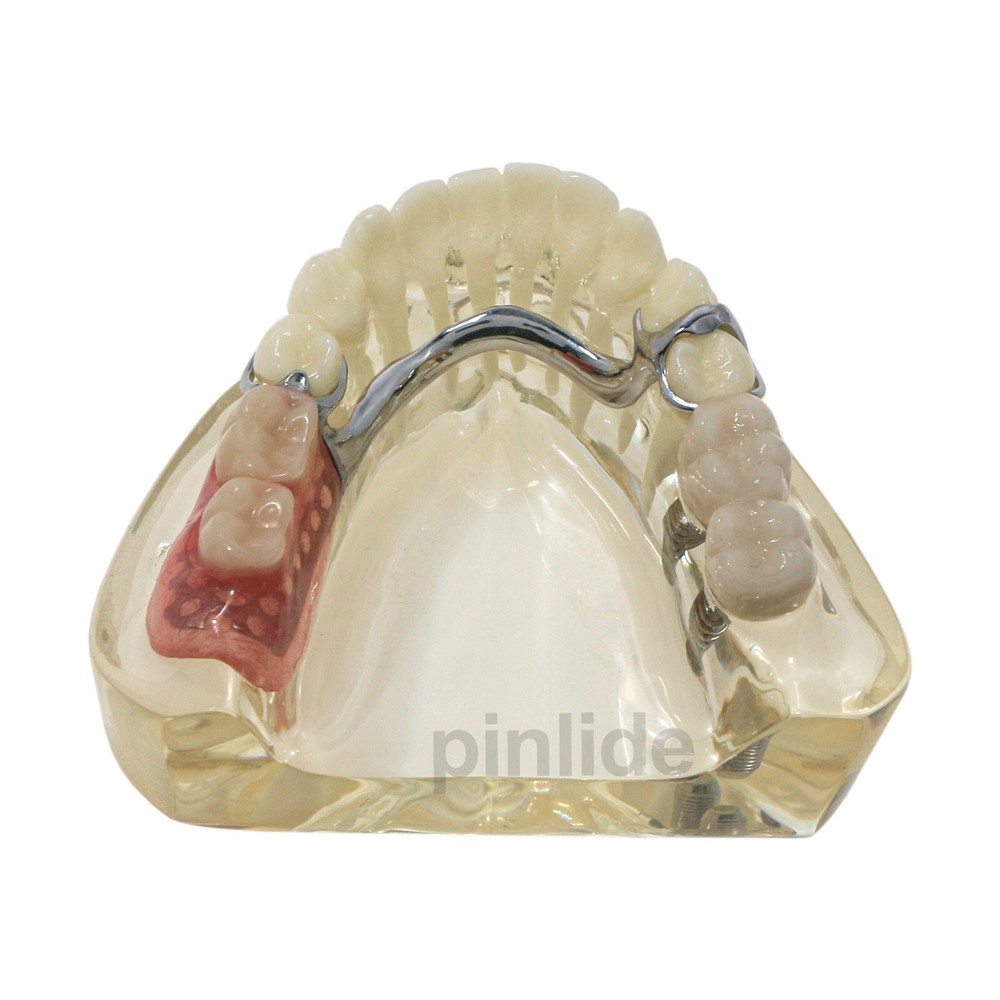 Dental Typodont Restoration Model With 2 Implants Partial Denture Demo M6022