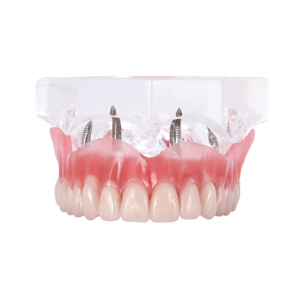 Dental Implant Teeth Model Restoration Overdenture Upper/Lower 4 Implants Demo