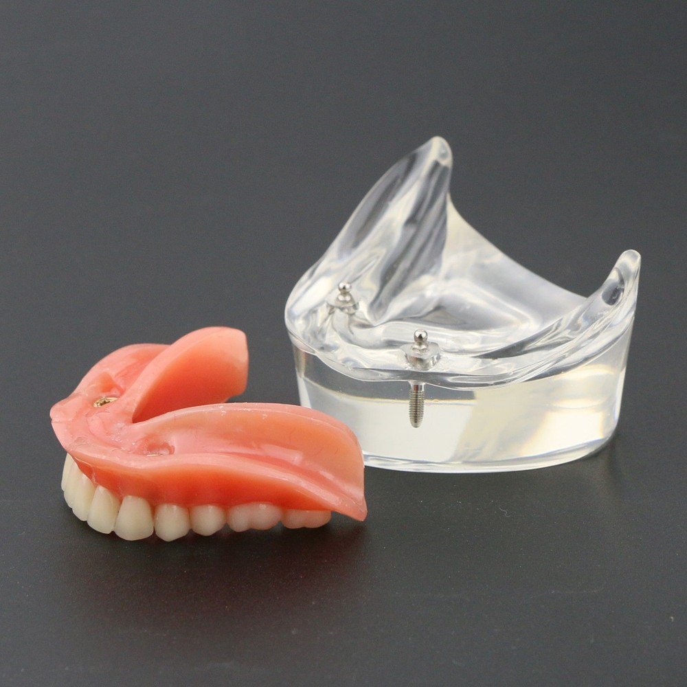 Sale Dental Model #6002 Overdenture Inferior 2 Implants Restroration Study 1Set