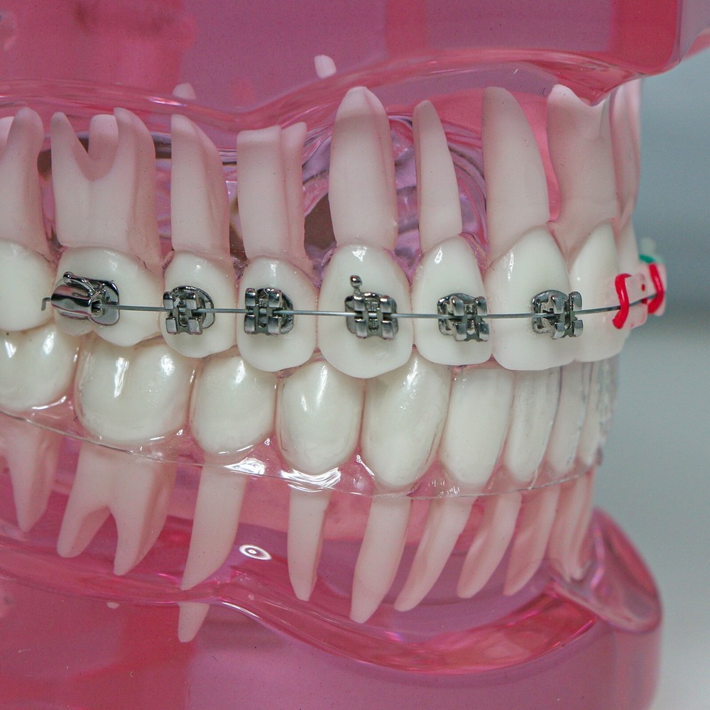 Dental Ortho Study Teach Teeth Model With Ceramic & Metal Brackets M3012 Pink