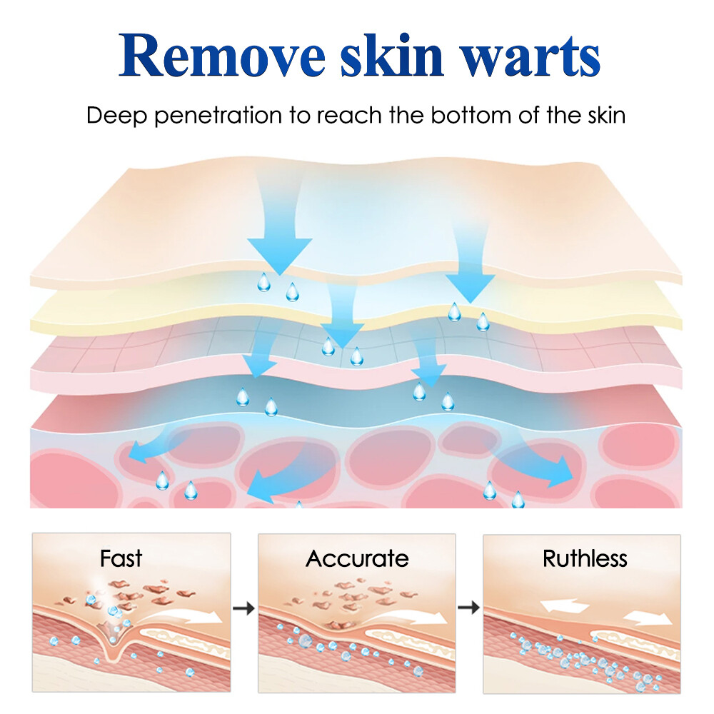 2Pack Wart Remover Liquid Skin Tag Mole Remover Eliminate Feet Corn Wart Remove