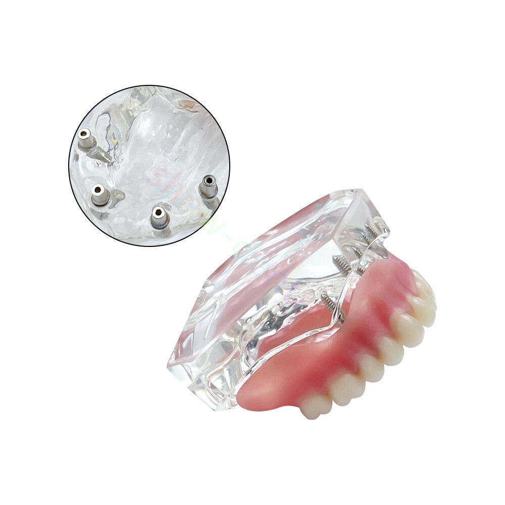 Upper/Lower jaw With 4 Implants Dental Mandibular Maxillary Teeth Model