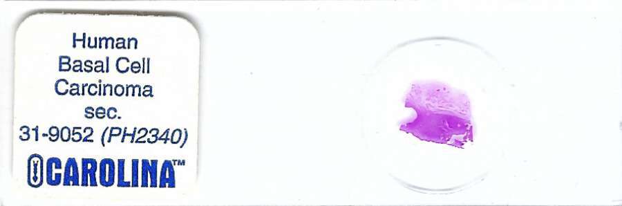 Human Basal Cell Carcinoma Pathology Microscope Slide