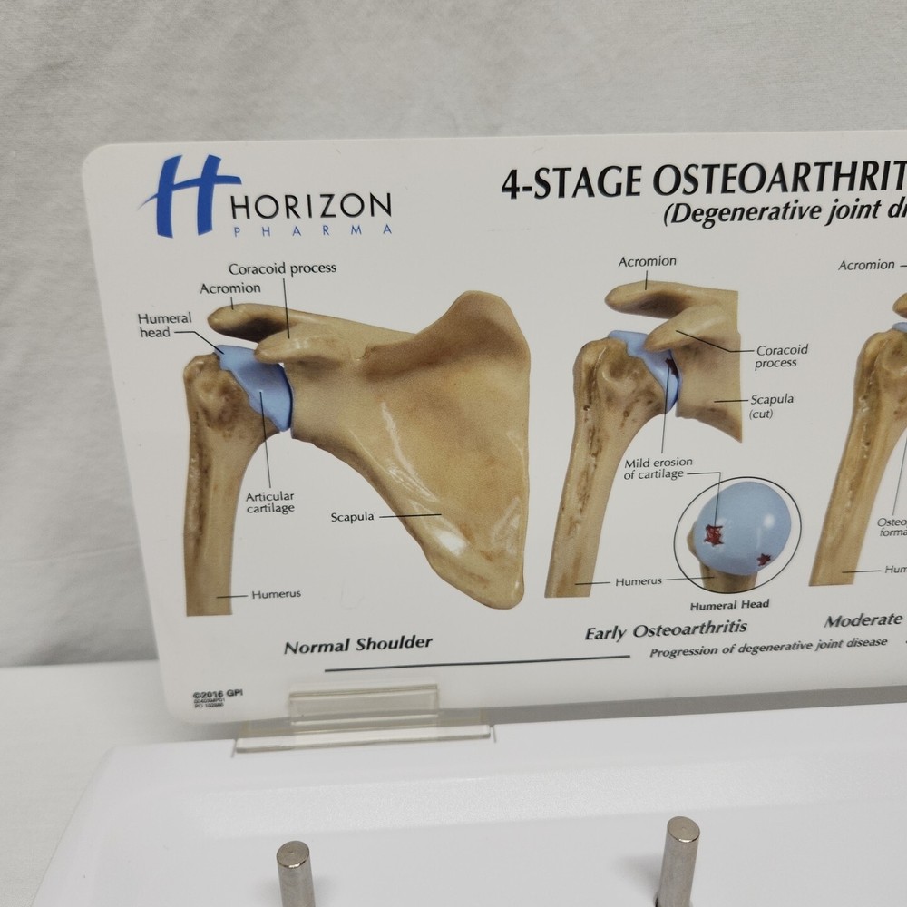 Degenerative Joint Disease 4 Stage Osteoarthritis Osteoarthritic Shoulder Model