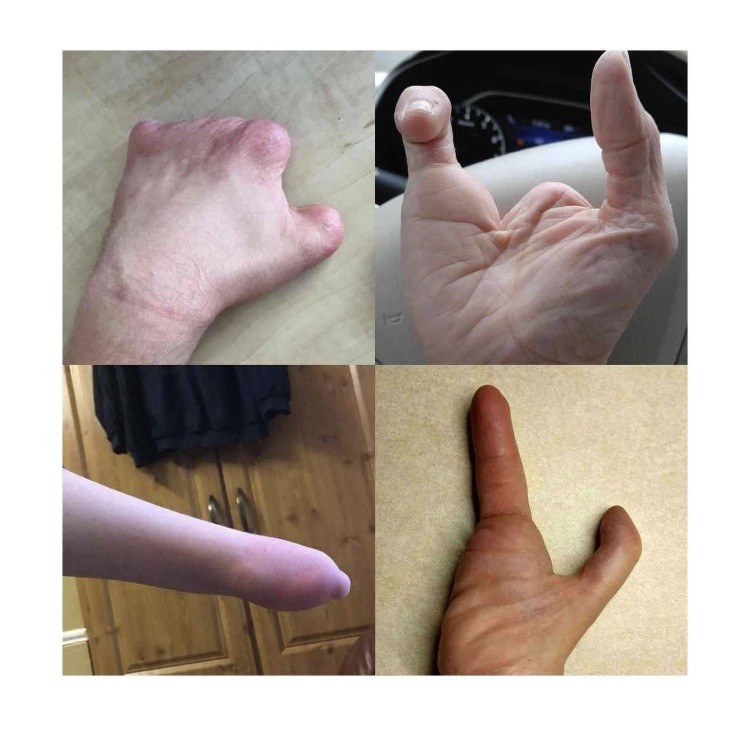 Active Hands Limb Difference Gripping Aid | Standard Size For Left Hand | Black