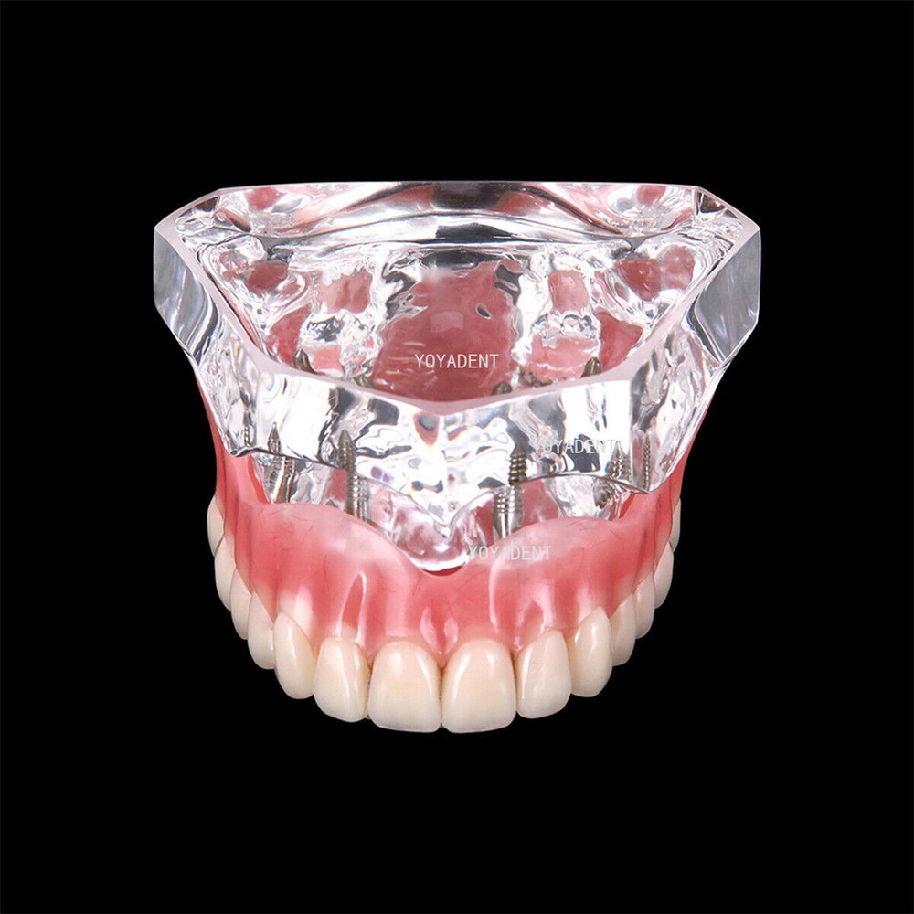 Dental Model 4 Implants superior/Mandibular Removable Overdenture Teeth Model