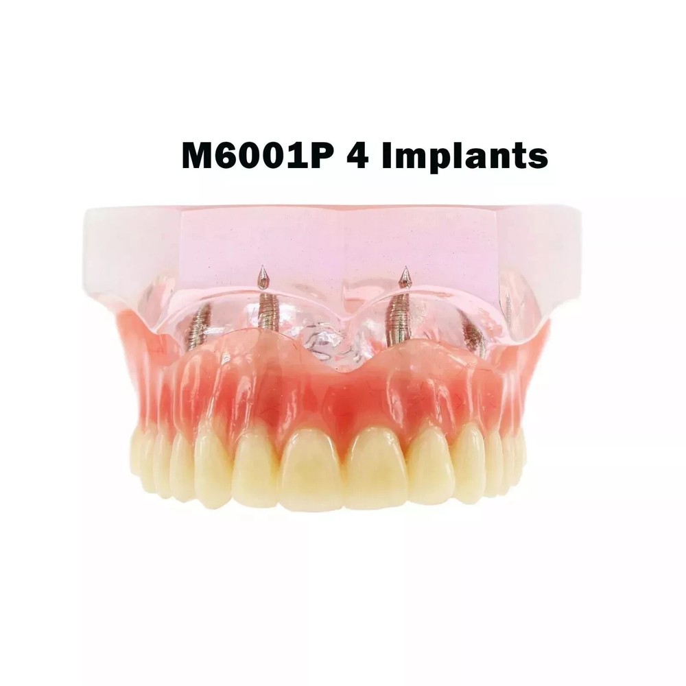 7 Types Dental Overdenture Restoration Model Implants Typodont Teaching Study