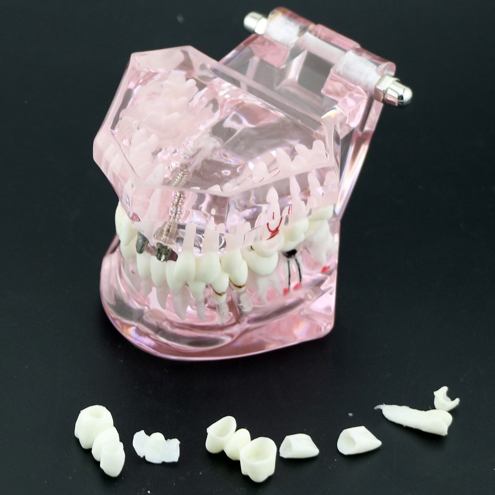 Dental Model Bridge Restoration Pathology Study Demo Teaching Model M2001