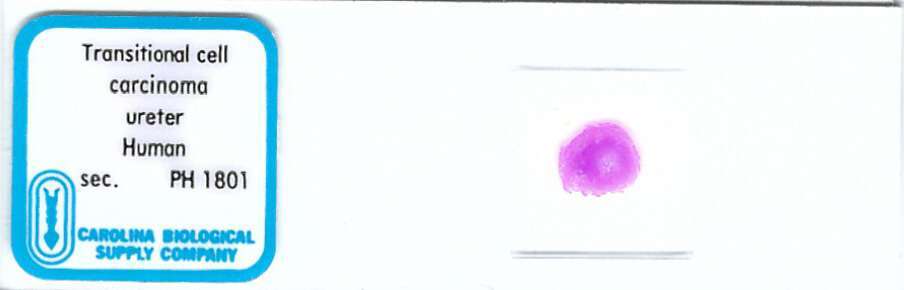 Human Transitional Cell Carcinoma of Ureter Pathology Microscope Slide