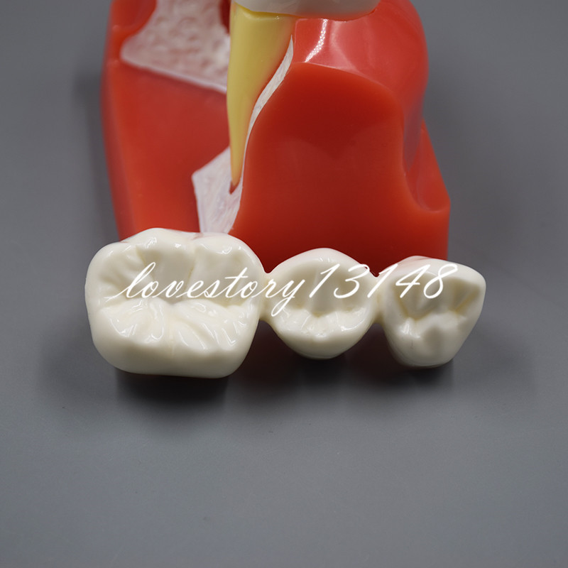 Dental Implant Analysis Crown Bridge Demonstration Teeth Tooth Study Model
