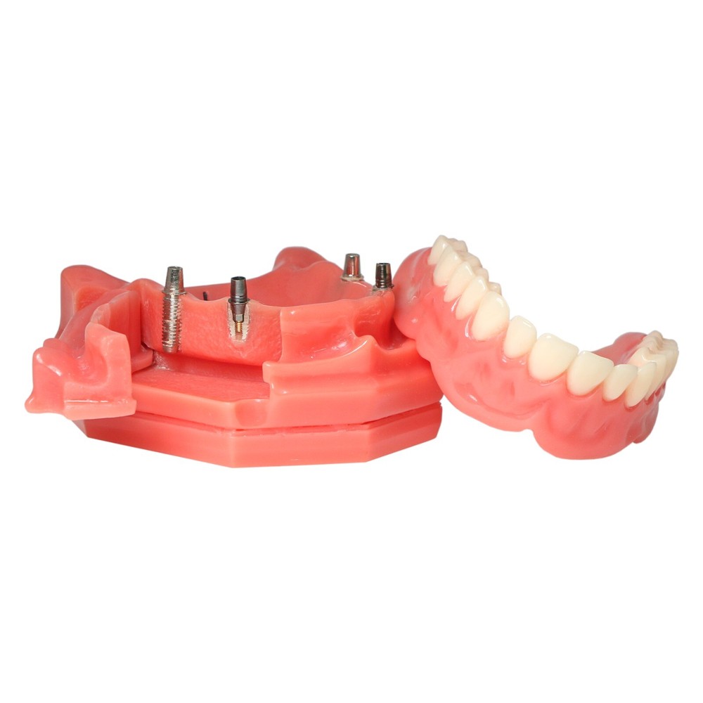 Dental Crown Restoration Model Demonstration With Partial Denture Tooth Mold Cov
