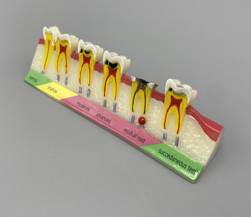 Dental Periodontal Caries Teeth Study Teaching Model Disease Assort Dentoform