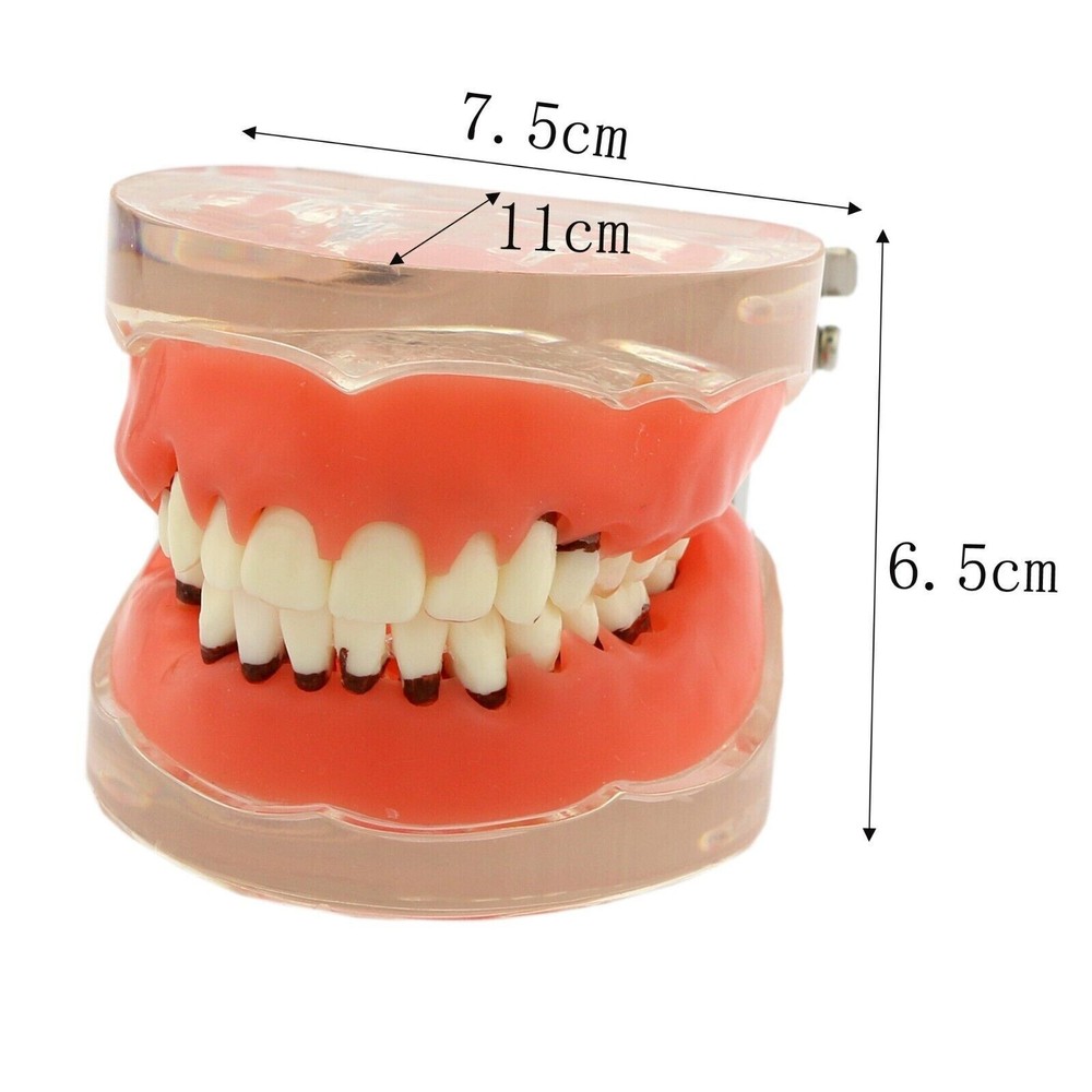 Dental Periodontal Pathological Disease M4017 Removable Teaching Study Model
