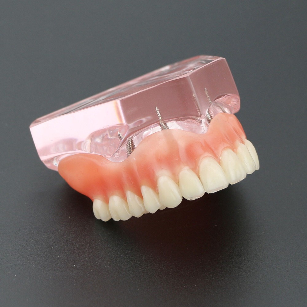 Dental Teeth Model Demo Overdenture Restoration With 4 Implants Upper Maxillary