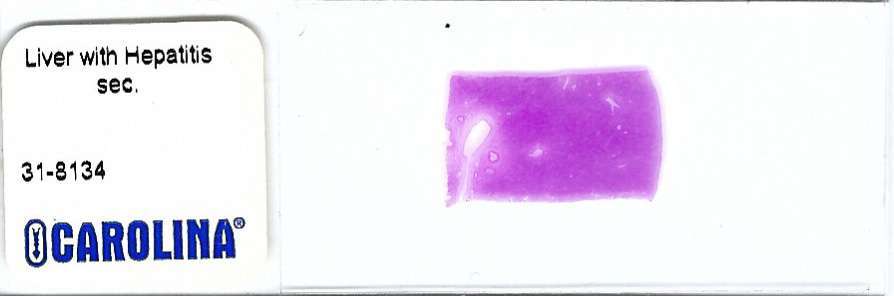 Human Liver with Hepatitis Pathology Microscope Slide