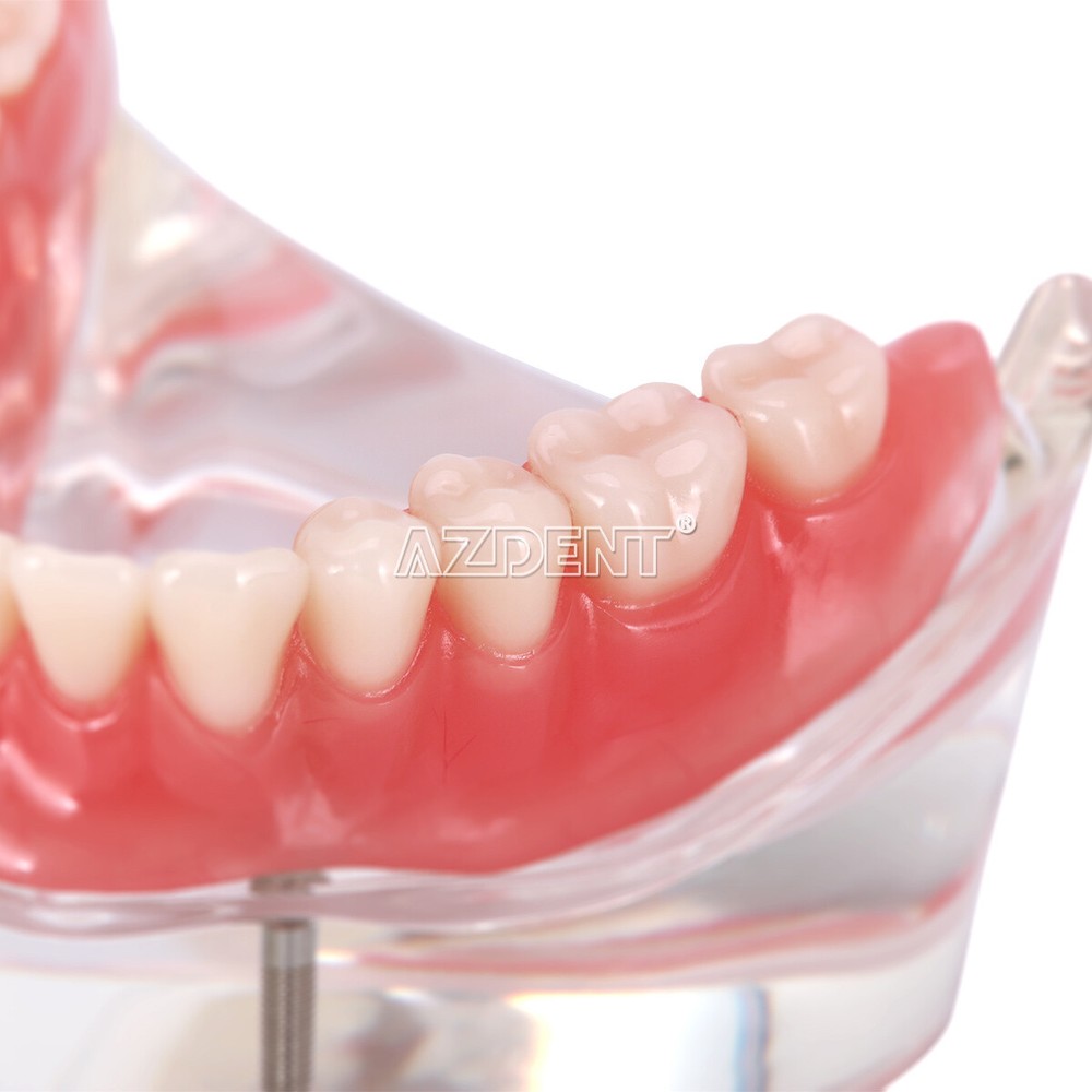 Dental Overdenture implant teeth model Denture with implant Demonstration Model