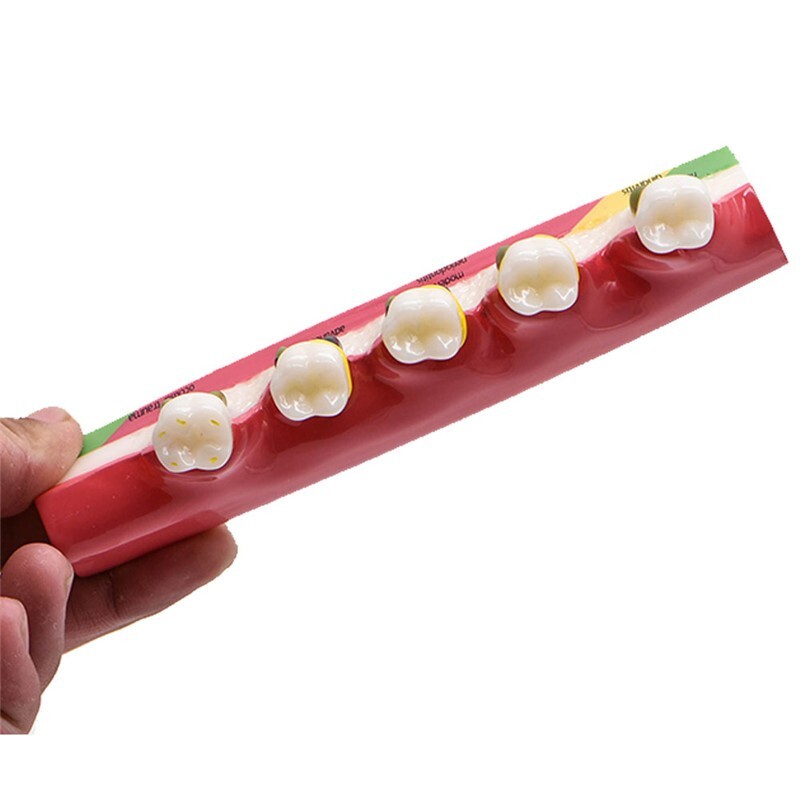 Dental Study Teaching Model Periodontal Disease Assort Teeth Dentoform Typodont