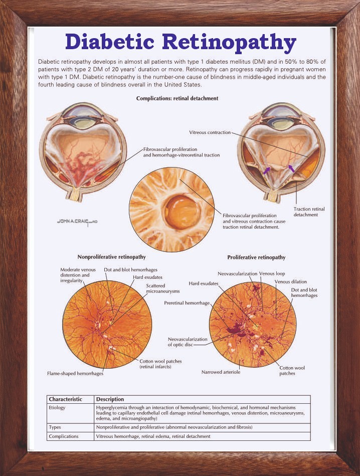 Diabetic Retinopathy Chart 12x18 inches