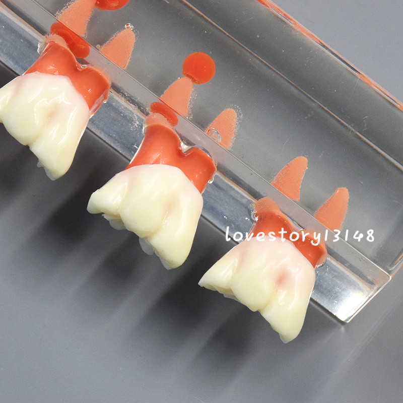 1 Set Dental Teeth Model #4018 01 - 4-Stage Endodontic Treatment Study Model