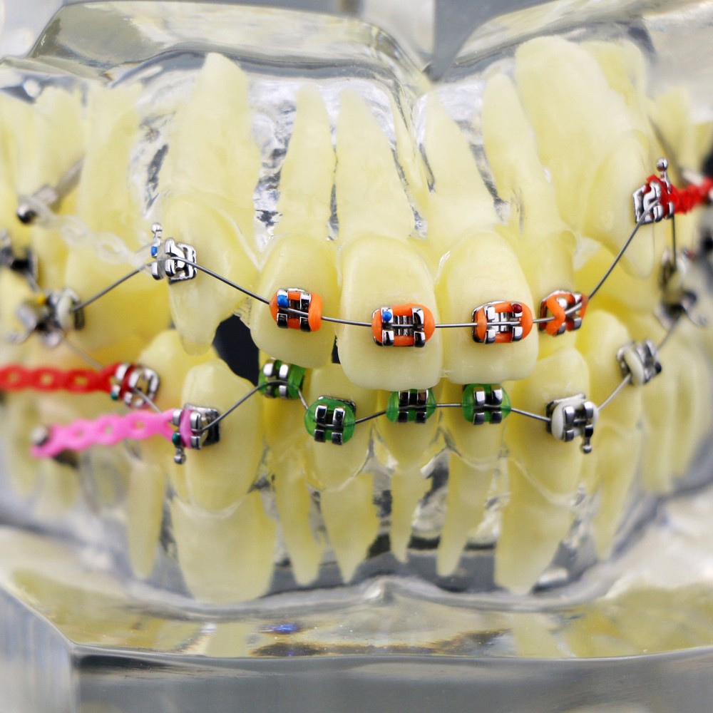 Dental Typodont Orthodontic Treatment Teeth Model Malocclusion Study w/ Bracket