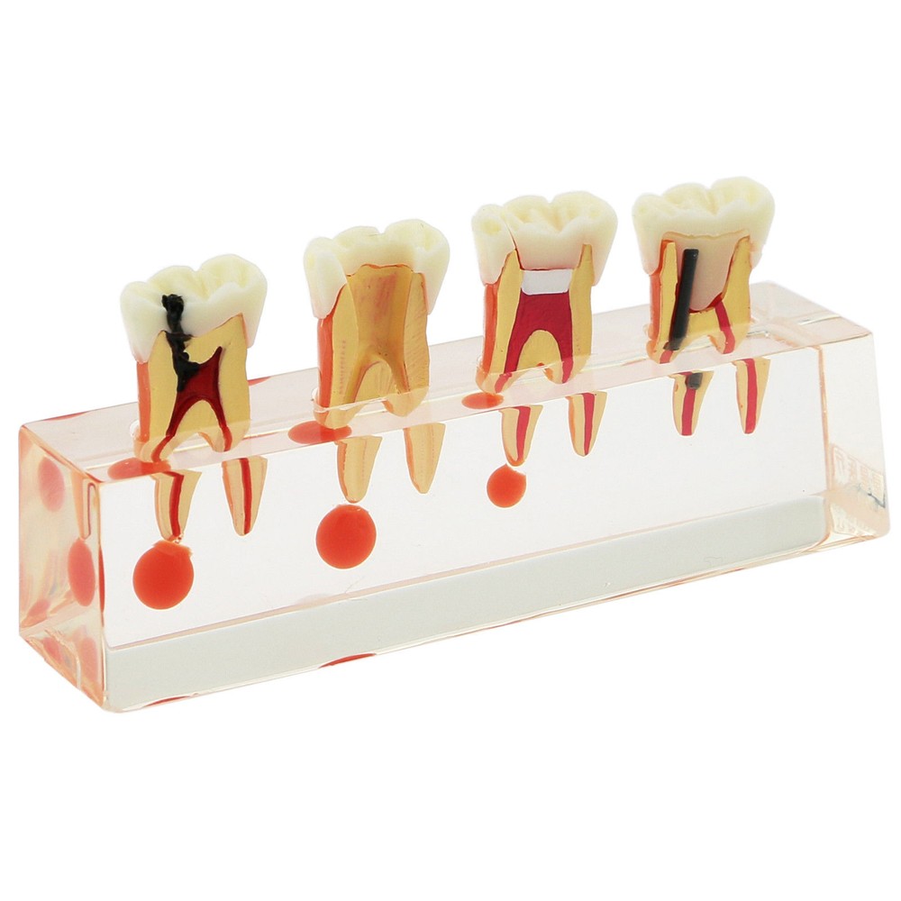 Dental Model 4-Stage Endodontic Treatment Teaching Communiction Demonstration