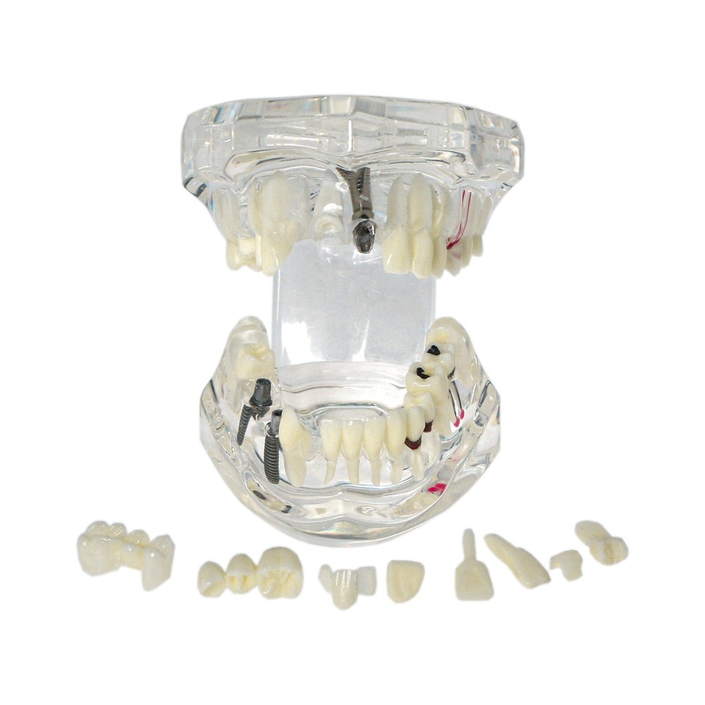 Implant Teeth Model Dental Typodont Ortho Pathological Perio Practice Demo Model