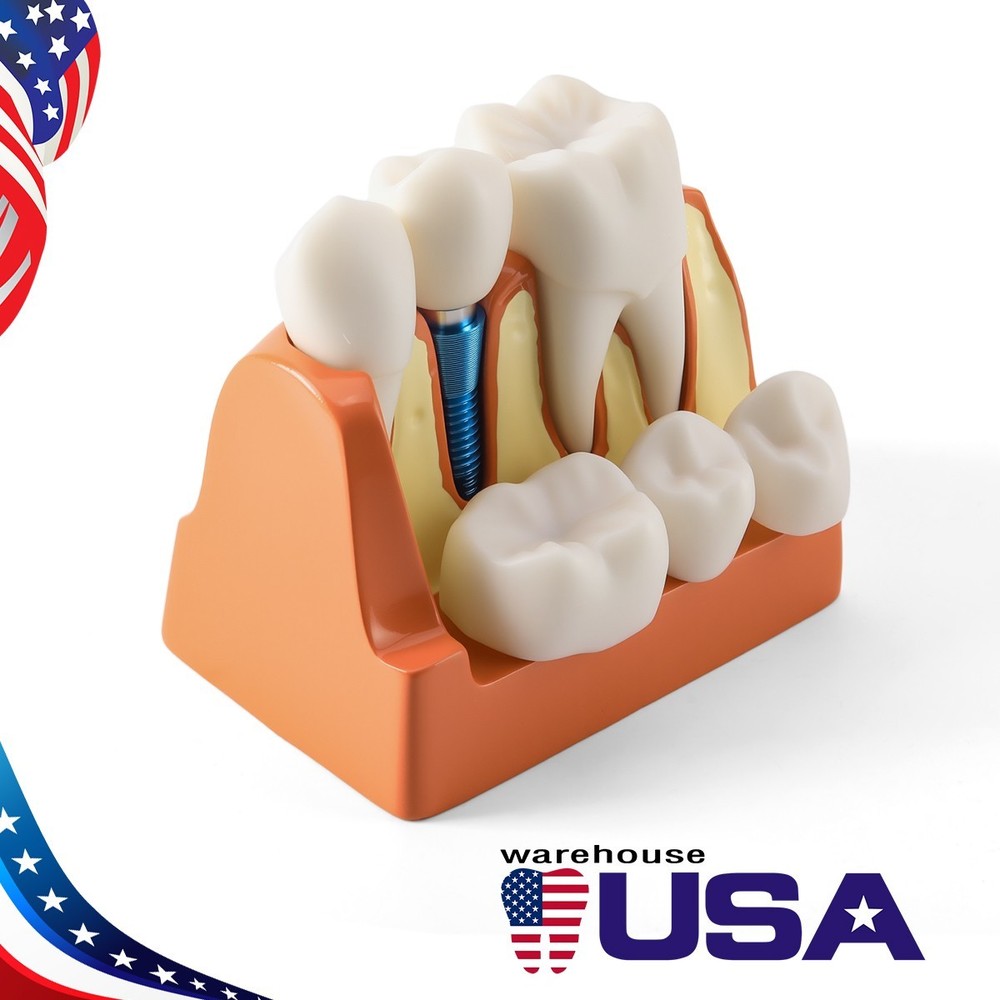 4 Times Dental Teeth Model Implant Crown Bridge Removable Study Teaching Tool