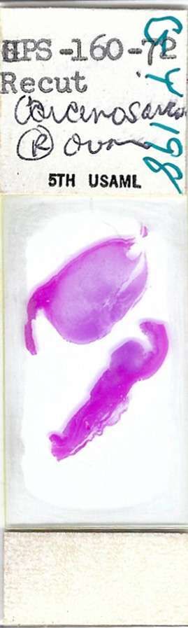Human Carcinosarcoma of Uterus Pathology Microscope Slide