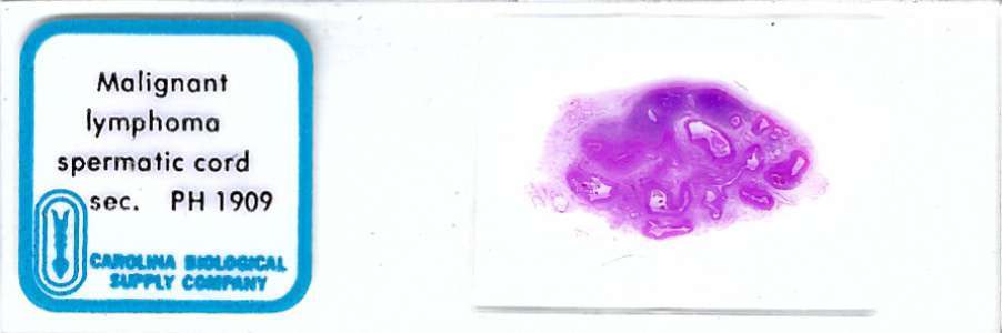 Human Malignant Lymphoma Spermatic Cord Pathology Microscope Slide