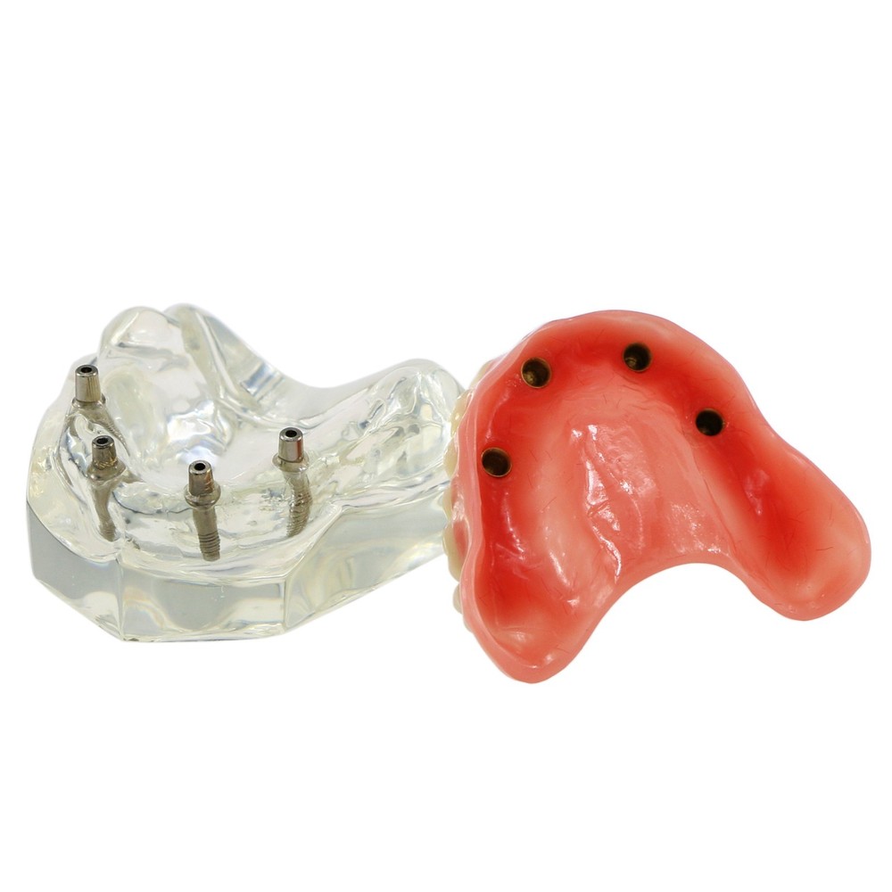 Dental Teeth Model Overdenture Removable Teeth Upper/Lower Jaw 4 Implants Model