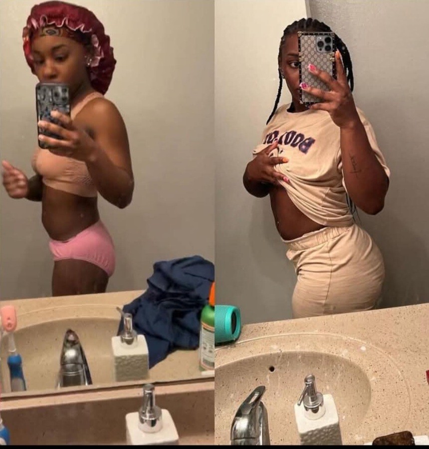 Buttocks Lift