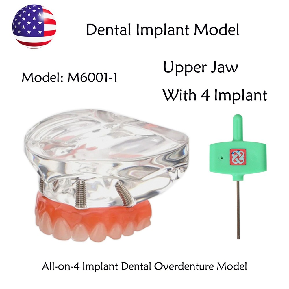 Dental Implant All-on-4 Overdenture Treatment Model Upper/Lower 4 Implants Clear